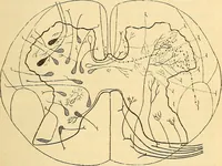 An illustration from Contribution à l'étude de l'atrophie musculaire progressive, type Duchenne-Aran / par le Dr. J. -B. Charcot. (1895)