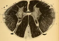 An illustration from Contribution à l'étude de l'atrophie musculaire progressive, type Duchenne-Aran / par le Dr. J. -B. Charcot. (1895)