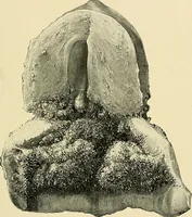 An illustration from Cancer of the uterus : its pathology, symptomatology, diagnosis, and treatment : also the pathology of diseases of the endometrium / by Thomas Stephen Cullen ; with eleven lithographic plates and over three hundred coloured and black illustrations in the text by May Brödel and Hermann Becker. (1900)