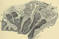 An illustration from Cancer of the uterus : its pathology, symptomatology, diagnosis, and treatment : also the pathology of diseases of the endometrium / by Thomas Stephen Cullen ; with eleven lithographic plates and over three hundred coloured and black illustrations in the text by May Brödel and Hermann Becker. (1900)