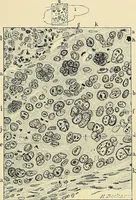 An illustration from Cancer of the uterus : its pathology, symptomatology, diagnosis, and treatment : also the pathology of diseases of the endometrium / by Thomas Stephen Cullen ; with eleven lithographic plates and over three hundred coloured and black illustrations in the text by May Brödel and Hermann Becker. (1900)