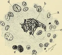 An illustration from Cancer of the uterus : its pathology, symptomatology, diagnosis, and treatment : also the pathology of diseases of the endometrium / by Thomas Stephen Cullen ; with eleven lithographic plates and over three hundred coloured and black illustrations in the text by May Brödel and Hermann Becker. (1900)
