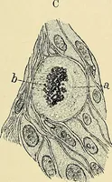 An illustration from Cancer of the uterus : its pathology, symptomatology, diagnosis, and treatment : also the pathology of diseases of the endometrium / by Thomas Stephen Cullen ; with eleven lithographic plates and over three hundred coloured and black illustrations in the text by May Brödel and Hermann Becker. (1900)
