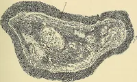 An illustration from Cancer of the uterus : its pathology, symptomatology, diagnosis, and treatment : also the pathology of diseases of the endometrium / by Thomas Stephen Cullen ; with eleven lithographic plates and over three hundred coloured and black illustrations in the text by May Brödel and Hermann Becker. (1900)