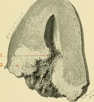 An illustration from Cancer of the uterus : its pathology, symptomatology, diagnosis, and treatment : also the pathology of diseases of the endometrium / by Thomas Stephen Cullen ; with eleven lithographic plates and over three hundred coloured and black illustrations in the text by May Brödel and Hermann Becker. (1900)