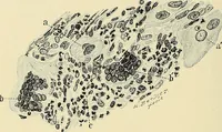 An illustration from Cancer of the uterus : its pathology, symptomatology, diagnosis, and treatment : also the pathology of diseases of the endometrium / by Thomas Stephen Cullen ; with eleven lithographic plates and over three hundred coloured and black illustrations in the text by May Brödel and Hermann Becker. (1900)