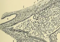 An illustration from Cancer of the uterus : its pathology, symptomatology, diagnosis, and treatment : also the pathology of diseases of the endometrium / by Thomas Stephen Cullen ; with eleven lithographic plates and over three hundred coloured and black illustrations in the text by May Brödel and Hermann Becker. (1900)