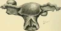 An illustration from Cancer of the uterus : its pathology, symptomatology, diagnosis, and treatment : also the pathology of diseases of the endometrium / by Thomas Stephen Cullen ; with eleven lithographic plates and over three hundred coloured and black illustrations in the text by May Brödel and Hermann Becker. (1900)