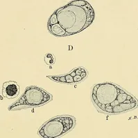 An illustration from Cancer of the uterus : its pathology, symptomatology, diagnosis, and treatment : also the pathology of diseases of the endometrium / by Thomas Stephen Cullen ; with eleven lithographic plates and over three hundred coloured and black illustrations in the text by May Brödel and Hermann Becker. (1900)