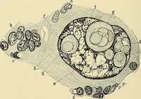 An illustration from Cancer of the uterus : its pathology, symptomatology, diagnosis, and treatment : also the pathology of diseases of the endometrium / by Thomas Stephen Cullen ; with eleven lithographic plates and over three hundred coloured and black illustrations in the text by May Brödel and Hermann Becker. (1900)