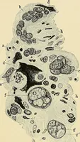 An illustration from Cancer of the uterus : its pathology, symptomatology, diagnosis, and treatment : also the pathology of diseases of the endometrium / by Thomas Stephen Cullen ; with eleven lithographic plates and over three hundred coloured and black illustrations in the text by May Brödel and Hermann Becker. (1900)