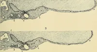 An illustration from Cancer of the uterus : its pathology, symptomatology, diagnosis, and treatment : also the pathology of diseases of the endometrium / by Thomas Stephen Cullen ; with eleven lithographic plates and over three hundred coloured and black illustrations in the text by May Brödel and Hermann Becker. (1900)