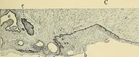 An illustration from Cancer of the uterus : its pathology, symptomatology, diagnosis, and treatment : also the pathology of diseases of the endometrium / by Thomas Stephen Cullen ; with eleven lithographic plates and over three hundred coloured and black illustrations in the text by May Brödel and Hermann Becker. (1900)