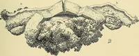 An illustration from Cancer of the uterus : its pathology, symptomatology, diagnosis, and treatment : also the pathology of diseases of the endometrium / by Thomas Stephen Cullen ; with eleven lithographic plates and over three hundred coloured and black illustrations in the text by May Brödel and Hermann Becker. (1900)