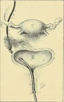 An illustration from Cancer of the uterus : its pathology, symptomatology, diagnosis, and treatment : also the pathology of diseases of the endometrium / by Thomas Stephen Cullen ; with eleven lithographic plates and over three hundred coloured and black illustrations in the text by May Brödel and Hermann Becker. (1900)