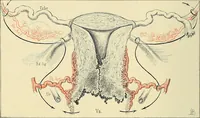 An illustration from Cancer of the uterus : its pathology, symptomatology, diagnosis, and treatment : also the pathology of diseases of the endometrium / by Thomas Stephen Cullen ; with eleven lithographic plates and over three hundred coloured and black illustrations in the text by May Brödel and Hermann Becker. (1900)