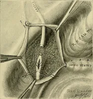 An illustration from Cancer of the uterus : its pathology, symptomatology, diagnosis, and treatment : also the pathology of diseases of the endometrium / by Thomas Stephen Cullen ; with eleven lithographic plates and over three hundred coloured and black illustrations in the text by May Brödel and Hermann Becker. (1900)