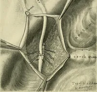 An illustration from Cancer of the uterus : its pathology, symptomatology, diagnosis, and treatment : also the pathology of diseases of the endometrium / by Thomas Stephen Cullen ; with eleven lithographic plates and over three hundred coloured and black illustrations in the text by May Brödel and Hermann Becker. (1900)