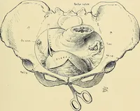 An illustration from Cancer of the uterus : its pathology, symptomatology, diagnosis, and treatment : also the pathology of diseases of the endometrium / by Thomas Stephen Cullen ; with eleven lithographic plates and over three hundred coloured and black illustrations in the text by May Brödel and Hermann Becker. (1900)