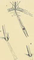 An illustration from Cancer of the uterus : its pathology, symptomatology, diagnosis, and treatment : also the pathology of diseases of the endometrium / by Thomas Stephen Cullen ; with eleven lithographic plates and over three hundred coloured and black illustrations in the text by May Brödel and Hermann Becker. (1900)