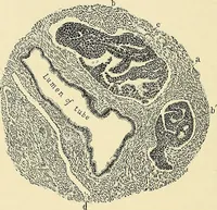 An illustration from Cancer of the uterus : its pathology, symptomatology, diagnosis, and treatment : also the pathology of diseases of the endometrium / by Thomas Stephen Cullen ; with eleven lithographic plates and over three hundred coloured and black illustrations in the text by May Brödel and Hermann Becker. (1900)