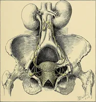 An illustration from Cancer of the uterus : its pathology, symptomatology, diagnosis, and treatment : also the pathology of diseases of the endometrium / by Thomas Stephen Cullen ; with eleven lithographic plates and over three hundred coloured and black illustrations in the text by May Brödel and Hermann Becker. (1900)