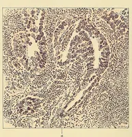 An illustration from Cancer of the uterus : its pathology, symptomatology, diagnosis, and treatment : also the pathology of diseases of the endometrium / by Thomas Stephen Cullen ; with eleven lithographic plates and over three hundred coloured and black illustrations in the text by May Brödel and Hermann Becker. (1900)