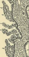 An illustration from Cancer of the uterus : its pathology, symptomatology, diagnosis, and treatment : also the pathology of diseases of the endometrium / by Thomas Stephen Cullen ; with eleven lithographic plates and over three hundred coloured and black illustrations in the text by May Brödel and Hermann Becker. (1900)