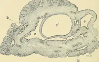An illustration from Cancer of the uterus : its pathology, symptomatology, diagnosis, and treatment : also the pathology of diseases of the endometrium / by Thomas Stephen Cullen ; with eleven lithographic plates and over three hundred coloured and black illustrations in the text by May Brödel and Hermann Becker. (1900)
