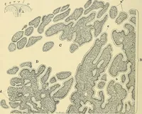 An illustration from Cancer of the uterus : its pathology, symptomatology, diagnosis, and treatment : also the pathology of diseases of the endometrium / by Thomas Stephen Cullen ; with eleven lithographic plates and over three hundred coloured and black illustrations in the text by May Brödel and Hermann Becker. (1900)