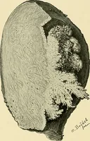 An illustration from Cancer of the uterus : its pathology, symptomatology, diagnosis, and treatment : also the pathology of diseases of the endometrium / by Thomas Stephen Cullen ; with eleven lithographic plates and over three hundred coloured and black illustrations in the text by May Brödel and Hermann Becker. (1900)