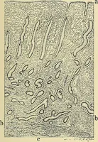 An illustration from Cancer of the uterus : its pathology, symptomatology, diagnosis, and treatment : also the pathology of diseases of the endometrium / by Thomas Stephen Cullen ; with eleven lithographic plates and over three hundred coloured and black illustrations in the text by May Brödel and Hermann Becker. (1900)