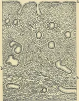 An illustration from Cancer of the uterus : its pathology, symptomatology, diagnosis, and treatment : also the pathology of diseases of the endometrium / by Thomas Stephen Cullen ; with eleven lithographic plates and over three hundred coloured and black illustrations in the text by May Brödel and Hermann Becker. (1900)