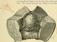 An illustration from Cancer of the uterus : its pathology, symptomatology, diagnosis, and treatment : also the pathology of diseases of the endometrium / by Thomas Stephen Cullen ; with eleven lithographic plates and over three hundred coloured and black illustrations in the text by May Brödel and Hermann Becker. (1900)