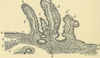 An illustration from Cancer of the uterus : its pathology, symptomatology, diagnosis, and treatment : also the pathology of diseases of the endometrium / by Thomas Stephen Cullen ; with eleven lithographic plates and over three hundred coloured and black illustrations in the text by May Brödel and Hermann Becker. (1900)