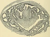 An illustration from Cancer of the uterus : its pathology, symptomatology, diagnosis, and treatment : also the pathology of diseases of the endometrium / by Thomas Stephen Cullen ; with eleven lithographic plates and over three hundred coloured and black illustrations in the text by May Brödel and Hermann Becker. (1900)