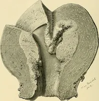 An illustration from Cancer of the uterus : its pathology, symptomatology, diagnosis, and treatment : also the pathology of diseases of the endometrium / by Thomas Stephen Cullen ; with eleven lithographic plates and over three hundred coloured and black illustrations in the text by May Brödel and Hermann Becker. (1900)