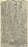 An illustration from Cancer of the uterus : its pathology, symptomatology, diagnosis, and treatment : also the pathology of diseases of the endometrium / by Thomas Stephen Cullen ; with eleven lithographic plates and over three hundred coloured and black illustrations in the text by May Brödel and Hermann Becker. (1900)