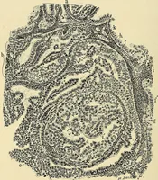 An illustration from Cancer of the uterus : its pathology, symptomatology, diagnosis, and treatment : also the pathology of diseases of the endometrium / by Thomas Stephen Cullen ; with eleven lithographic plates and over three hundred coloured and black illustrations in the text by May Brödel and Hermann Becker. (1900)