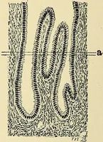 An illustration from Cancer of the uterus : its pathology, symptomatology, diagnosis, and treatment : also the pathology of diseases of the endometrium / by Thomas Stephen Cullen ; with eleven lithographic plates and over three hundred coloured and black illustrations in the text by May Brödel and Hermann Becker. (1900)