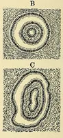 An illustration from Cancer of the uterus : its pathology, symptomatology, diagnosis, and treatment : also the pathology of diseases of the endometrium / by Thomas Stephen Cullen ; with eleven lithographic plates and over three hundred coloured and black illustrations in the text by May Brödel and Hermann Becker. (1900)