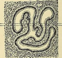 An illustration from Cancer of the uterus : its pathology, symptomatology, diagnosis, and treatment : also the pathology of diseases of the endometrium / by Thomas Stephen Cullen ; with eleven lithographic plates and over three hundred coloured and black illustrations in the text by May Brödel and Hermann Becker. (1900)