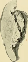 An illustration from Cancer of the uterus : its pathology, symptomatology, diagnosis, and treatment : also the pathology of diseases of the endometrium / by Thomas Stephen Cullen ; with eleven lithographic plates and over three hundred coloured and black illustrations in the text by May Brödel and Hermann Becker. (1900)