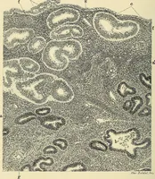 An illustration from Cancer of the uterus : its pathology, symptomatology, diagnosis, and treatment : also the pathology of diseases of the endometrium / by Thomas Stephen Cullen ; with eleven lithographic plates and over three hundred coloured and black illustrations in the text by May Brödel and Hermann Becker. (1900)