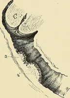 An illustration from Cancer of the uterus : its pathology, symptomatology, diagnosis, and treatment : also the pathology of diseases of the endometrium / by Thomas Stephen Cullen ; with eleven lithographic plates and over three hundred coloured and black illustrations in the text by May Brödel and Hermann Becker. (1900)
