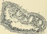 An illustration from Cancer of the uterus : its pathology, symptomatology, diagnosis, and treatment : also the pathology of diseases of the endometrium / by Thomas Stephen Cullen ; with eleven lithographic plates and over three hundred coloured and black illustrations in the text by May Brödel and Hermann Becker. (1900)