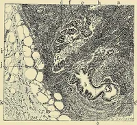 An illustration from Cancer of the uterus : its pathology, symptomatology, diagnosis, and treatment : also the pathology of diseases of the endometrium / by Thomas Stephen Cullen ; with eleven lithographic plates and over three hundred coloured and black illustrations in the text by May Brödel and Hermann Becker. (1900)
