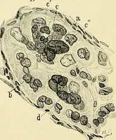 An illustration from Cancer of the uterus : its pathology, symptomatology, diagnosis, and treatment : also the pathology of diseases of the endometrium / by Thomas Stephen Cullen ; with eleven lithographic plates and over three hundred coloured and black illustrations in the text by May Brödel and Hermann Becker. (1900)