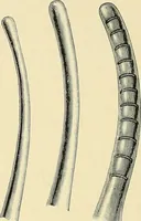 An illustration from Cancer of the uterus : its pathology, symptomatology, diagnosis, and treatment : also the pathology of diseases of the endometrium / by Thomas Stephen Cullen ; with eleven lithographic plates and over three hundred coloured and black illustrations in the text by May Brödel and Hermann Becker. (1900)