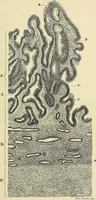 An illustration from Cancer of the uterus : its pathology, symptomatology, diagnosis, and treatment : also the pathology of diseases of the endometrium / by Thomas Stephen Cullen ; with eleven lithographic plates and over three hundred coloured and black illustrations in the text by May Brödel and Hermann Becker. (1900)